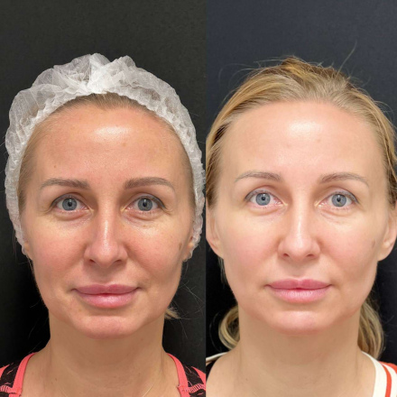 Фотоомоложение на аппарате Estetica 3.0+биоревитализация